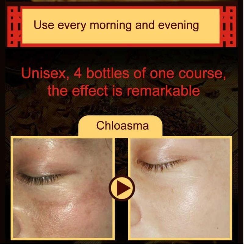 100% ORIGINAL Freckle Cream Anti-dark Spots and Brightening Skin Whitening Cream