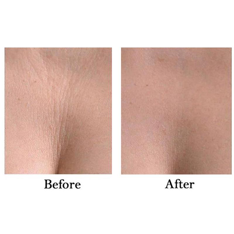 Набор многоразовых силиконовых патчей для лифтинга лица и шеи 