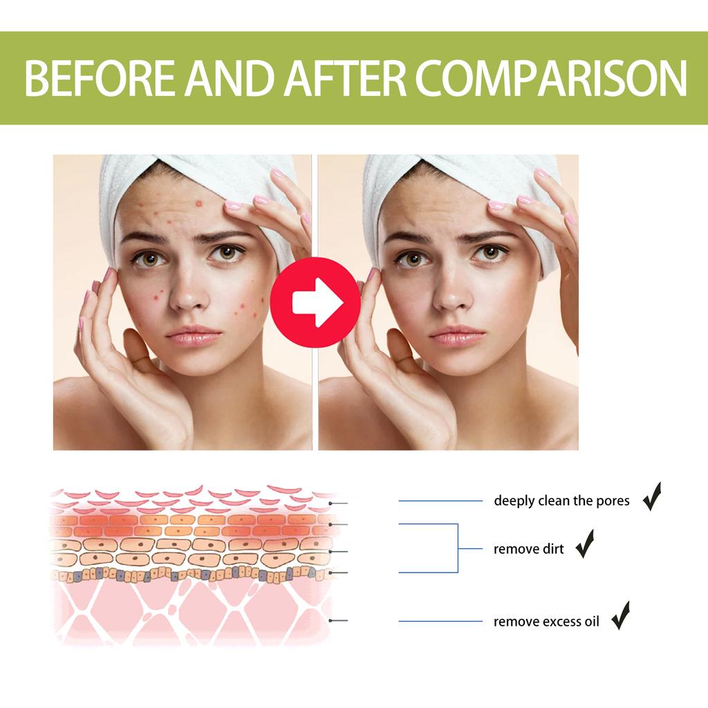 Eelhoe Tea Tree Anti-acne Essence Reduces Acne Pimples Fine Lines Clears Skin Tightens Pores And Moisturizes Skin Essence