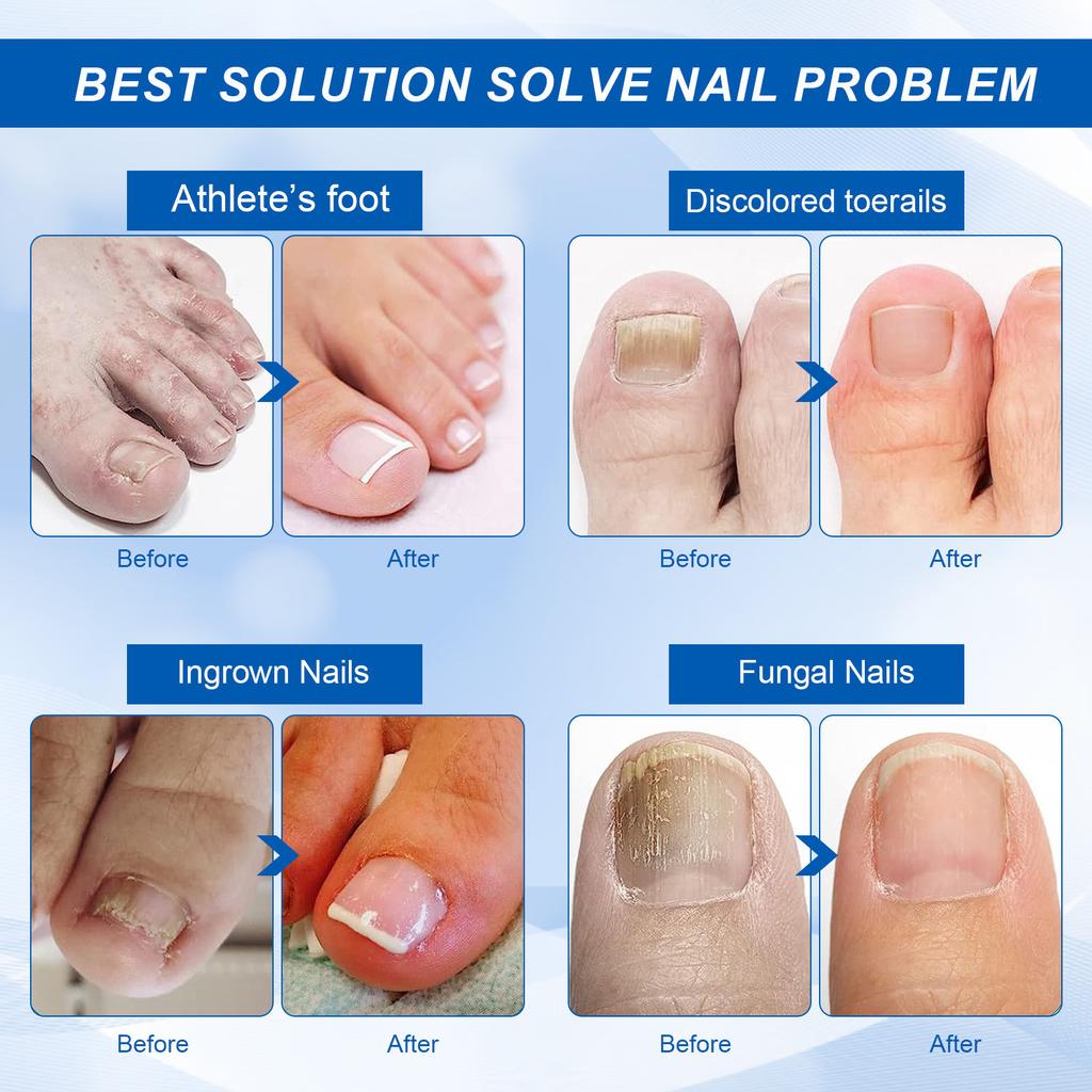 Масло для ногтей от бороздок 30 мл. Масло для ногтей от вросших ногтей, воспаление, поддержание здоровья ногтей, смягчение масла для ногтей от бороздок