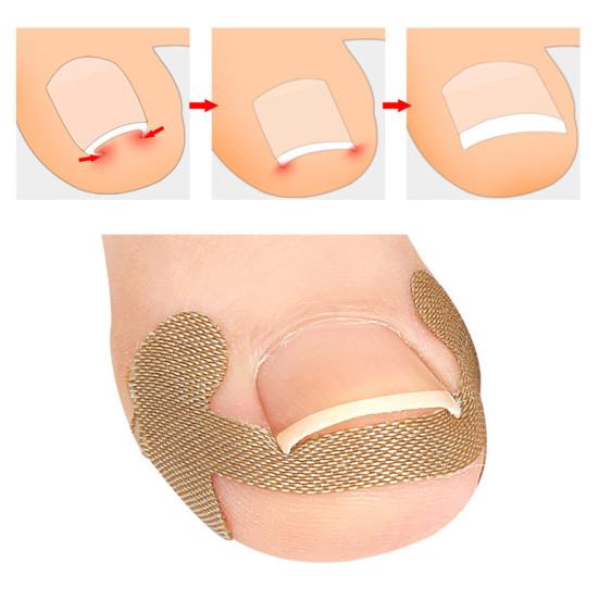 1 комплект, набор для коррекции ногтей на ногах, аксессуары для ухода без клея, премиум-корректор для маникюрного салона