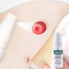 15 мл спрей-очиститель для колостомы, спрей для удаления клея для стомы, медицинский клей для удаления клея, средства по уходу за мешком для стомы