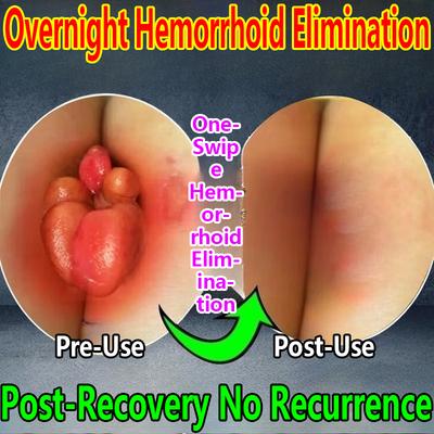 Успокаивающий крем для облегчения боли при иссечении прямой кишки, внутреннем геморрое и наружном геморрое, смешанном геморрое