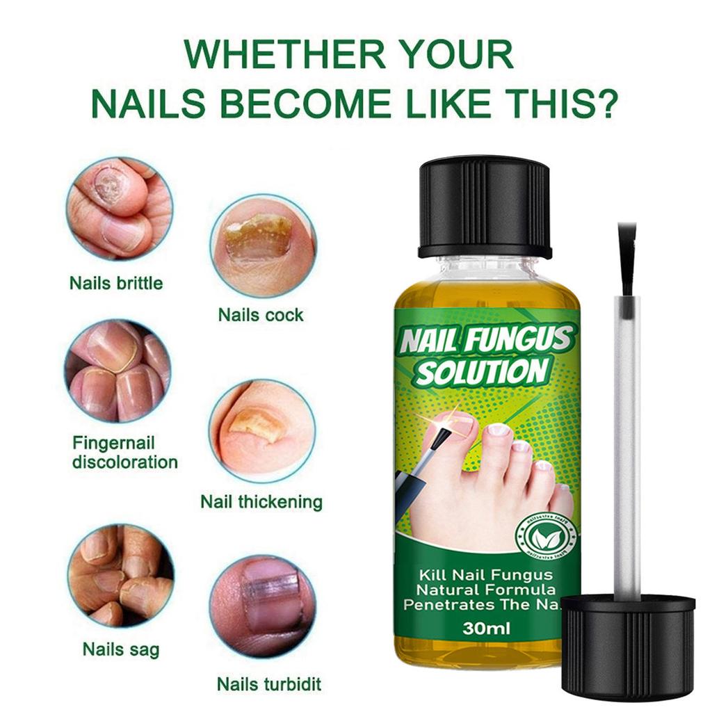 Toenail Fungus Care, FastActing Nail Care Liquid For Fungus Under & Around Restores The Healthy Appearance Of Nails 30ml