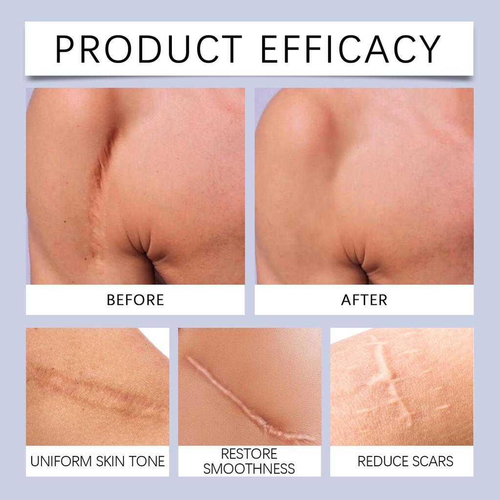 Улучшенный силиконовый гель для кожи, нежное увлажнение и осветление растяжек, осветление тонких линий и удаление геля для разглаживания кожи, 30 г