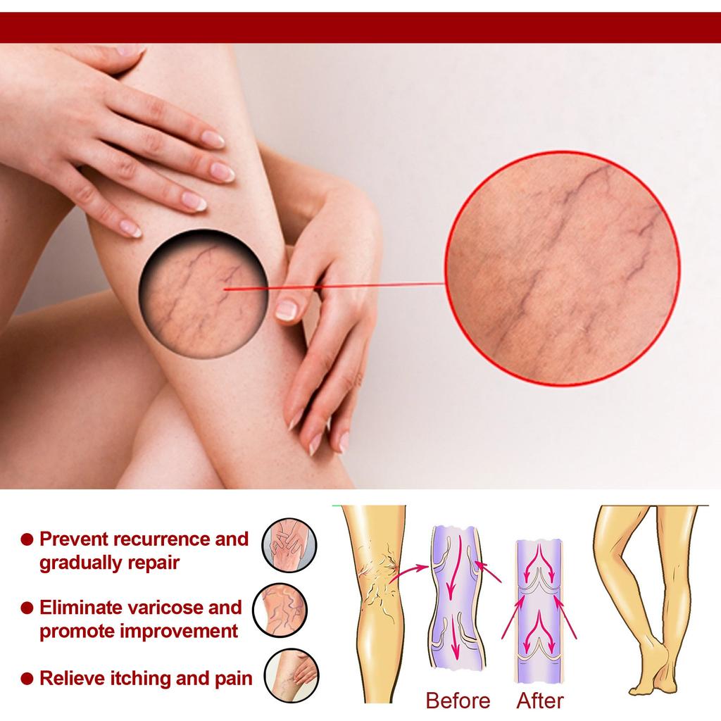 Паста от варикозного расширения вен, паста от варикозного расширения вен, варикозное расширение вен и сосудистые звездочки облегчают состояние ног, улучшают кровообращение
