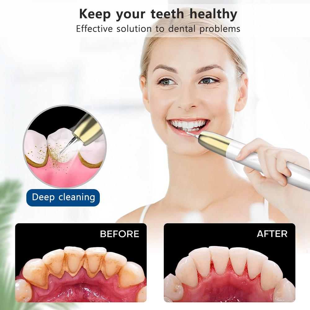 Dental Scaler Ultrasonic Tooth Cleaner Tartar Eliminator Plaque Calculus Remover Electric Removal Teeth Stain Dental Scaling G11