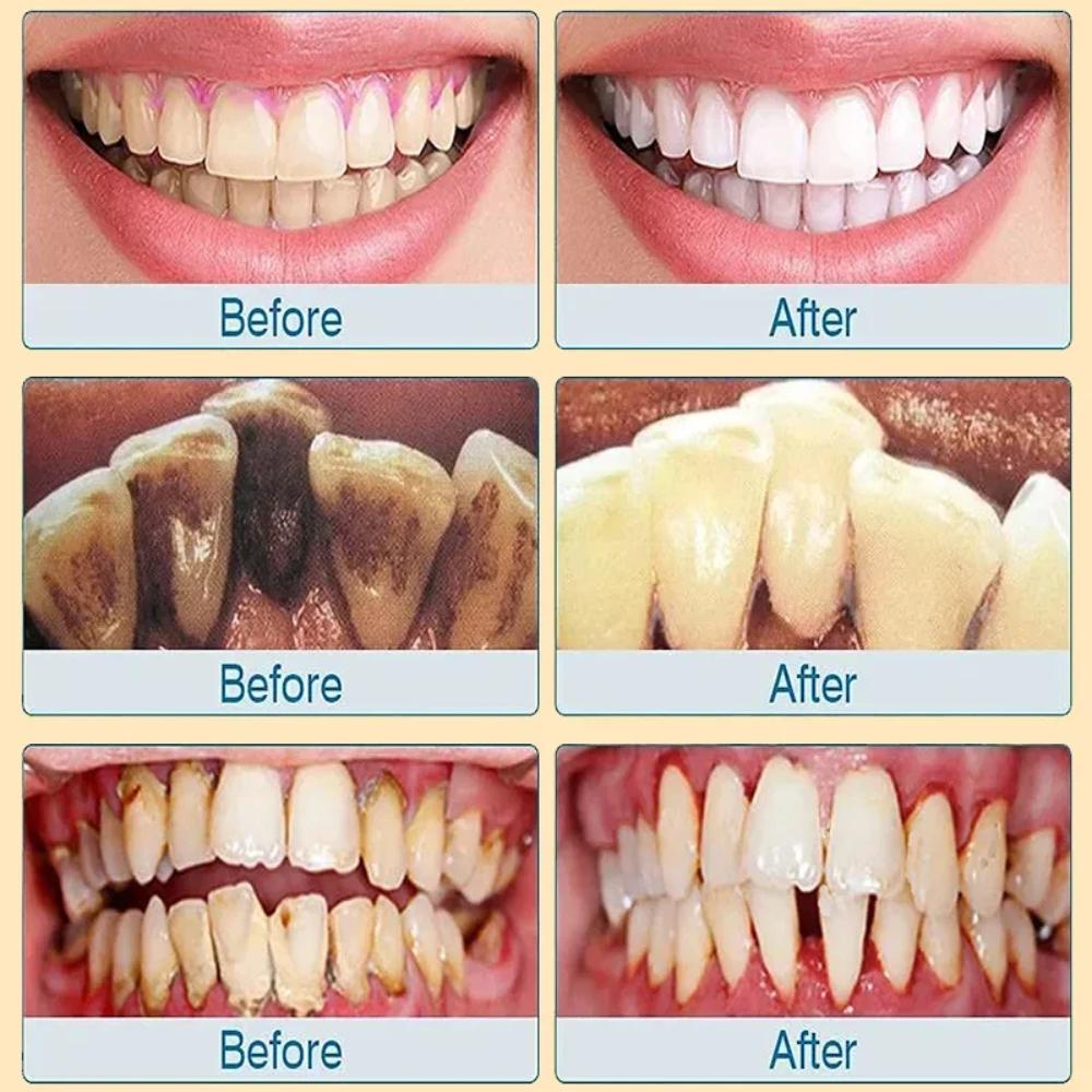 100g Whitening Toothpaste Remover Dental Calculus Whitening Teeth Mouth Odor Removal Bad Breath Preventing Periodontitis