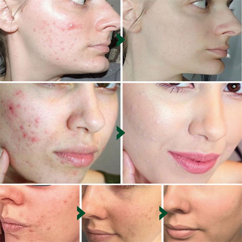 5 мл/15 мл/30 мл/50 мл/натуральное масло чайного дерева, увлажняющее, для лица, тела, женский уход за кожей, восстановление кожи, увлажняющее, ароматерапия, чистое массажное эфирное масло