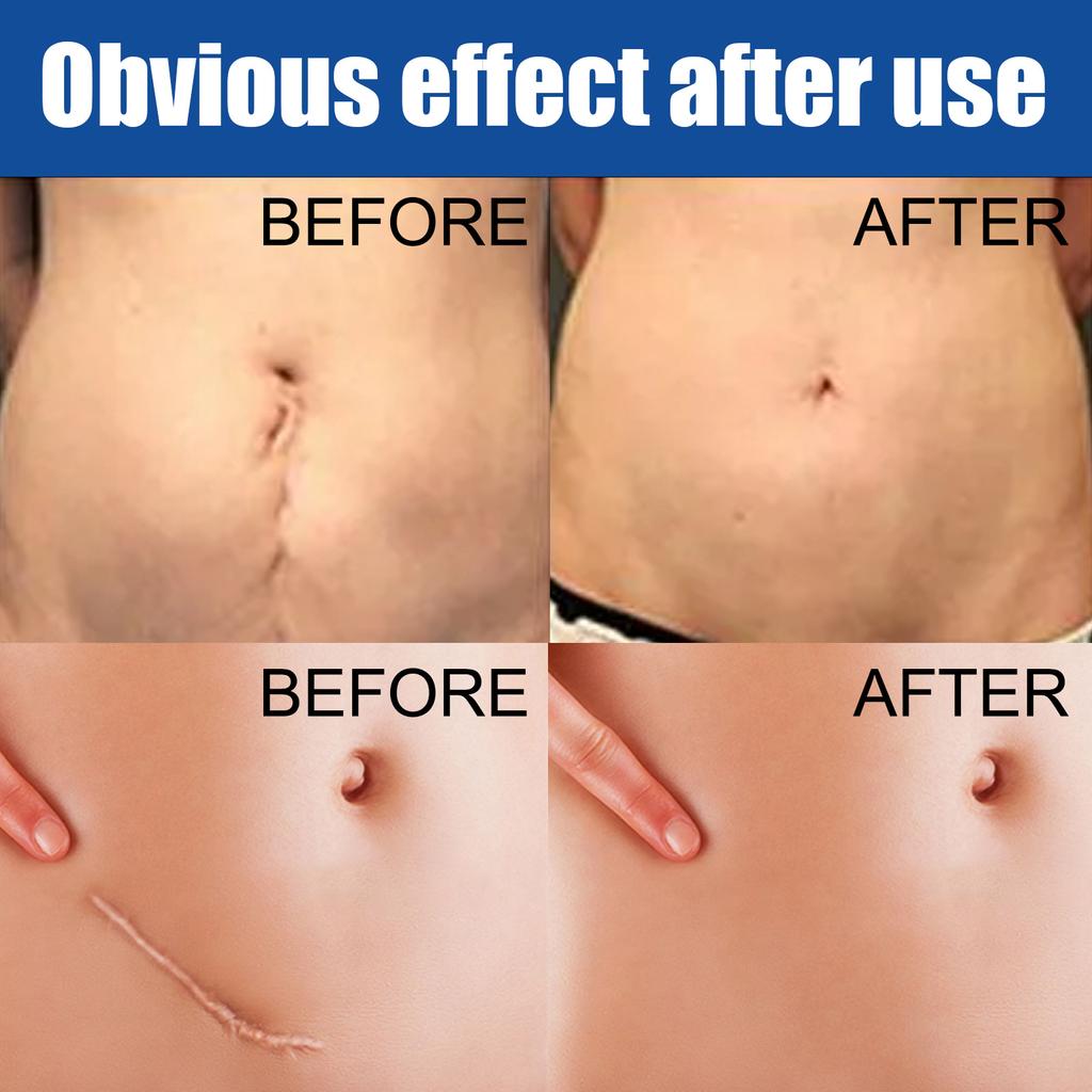 EELHOE Herbal Acne Scar Removal Cream Stretch Marks Remove Face Body Burn Surgical Scars Treatment Scar Remove Serum