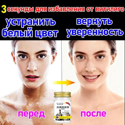 Петрощенк импортная мазь от витилиго специальная мазь для заболевания кожи с белыми пятнами