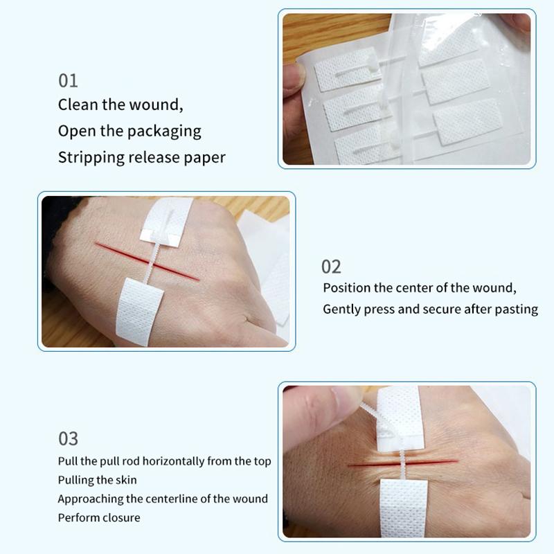 1 шт., пластырь на молнии, безболезненное устройство для закрытия ран, без швов, пластыри для повязки на рану, пластырь для уменьшения швов на молнии