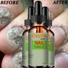 Hand and Foot Nail Onycho Repair Nail Onychomycetant for Thickening Nail Suppressant