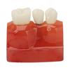 4 Times Dental Implant Model Crown Bridge Implant Teeth Demonstration Model for Doctors Patient