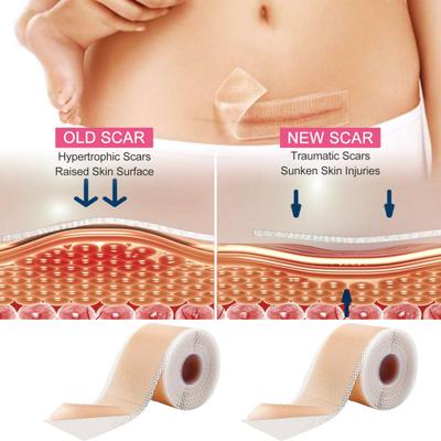Силиконовые пластыри для рубцов, рулон ленты для рубцов, профессиональные мягкие полоски для рубцов после хирургических операций, келоидные рубцы, лечение угревой сыпи, силиконовый гелевый пластырь