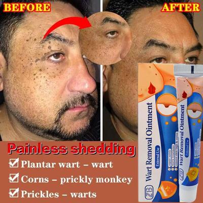 Крем для удаления мозолей и родинок