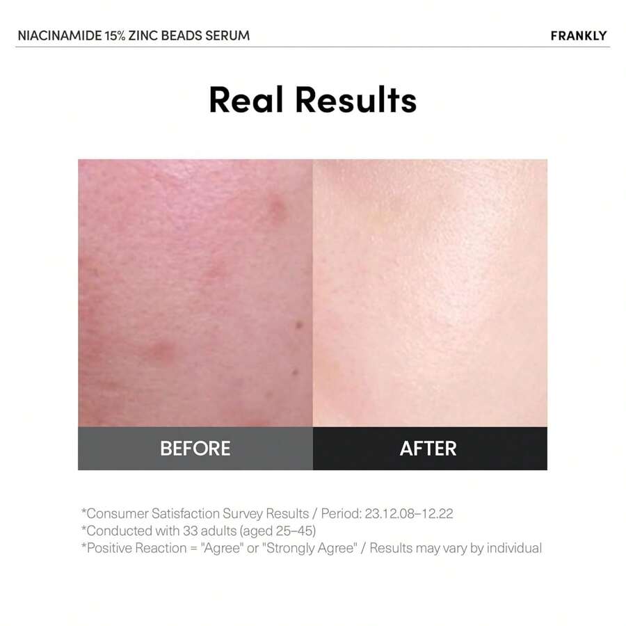 FRANKLY Сыворотка с ниацинамидом 15% и цинковыми гранулами 30 мл : Уход против акне и пигментных пятен, контроль жирности, ровный тон и сияние кожи | Веганский и не тестируется на животных