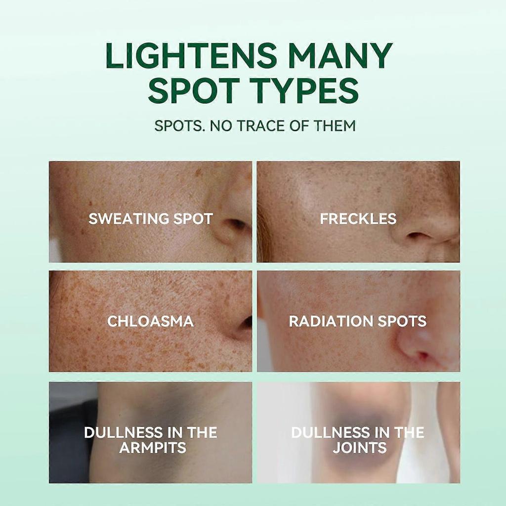 Hoygi Dark Spot Correcting Serum  Fades Facial Spots And Sunspots, Brightens Elbows, Smooths Skin, And Evens Out Skin Tone