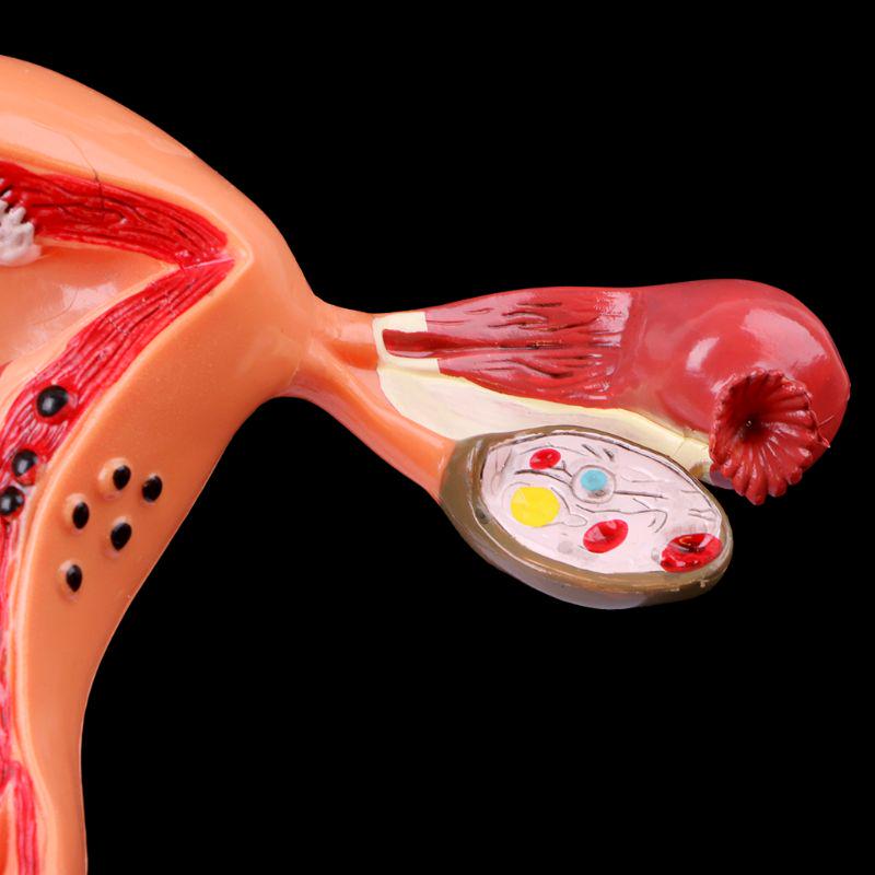 Pathological Uterus Ovary Anatomical Model Anatomy Cross Section Study Tool