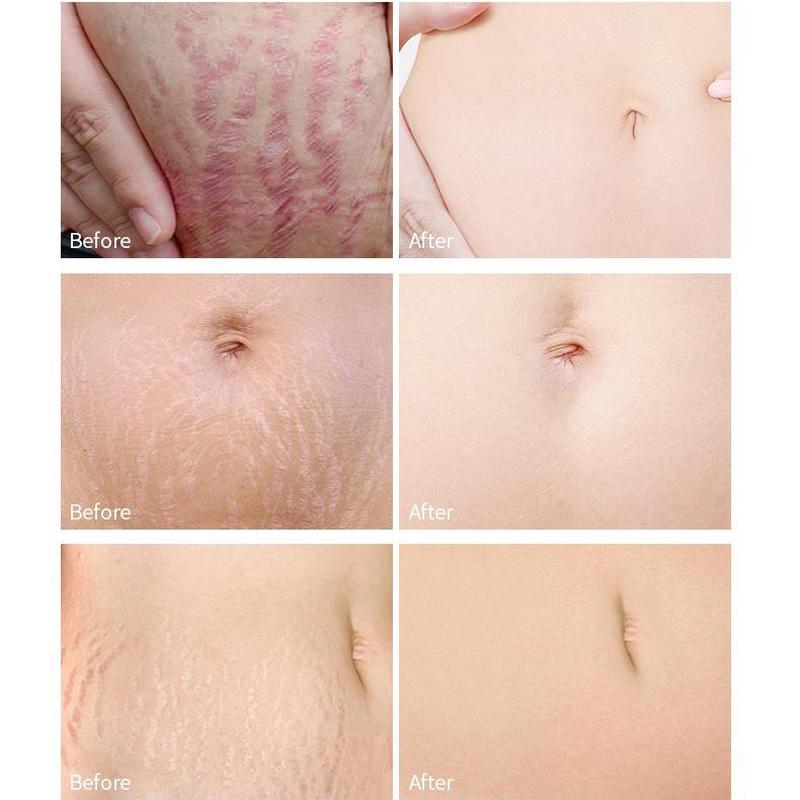 Крем для восстановления растяжек для беременных женщин. Послеродовое восстановление и исчезновение растяжек.