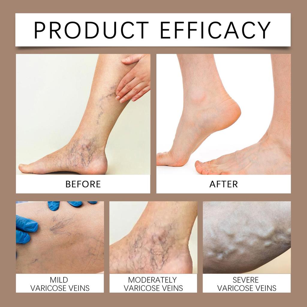 Мазь от варикозного расширения вен Устраняет сосудистые звездочки Облегчает васкулит Флебит Массаж Увлажняющий крем для ног для лечения боли