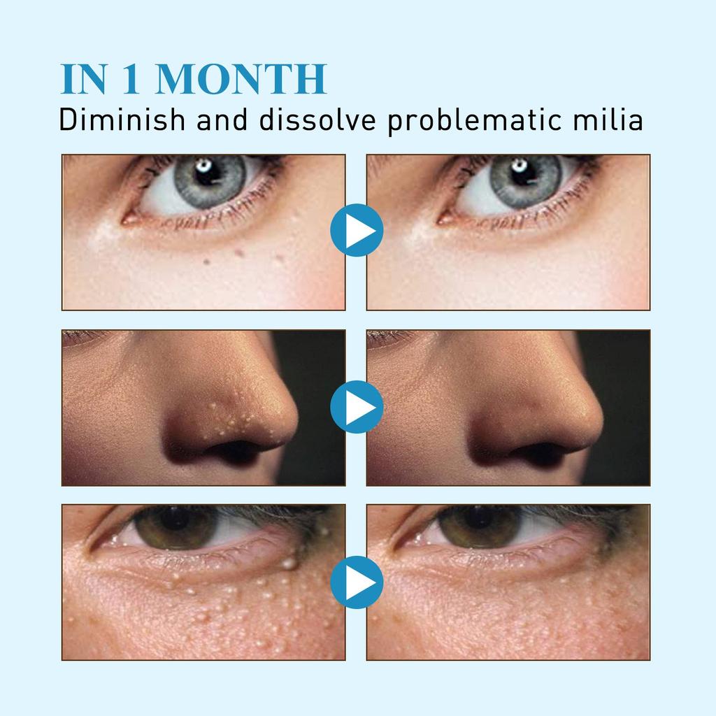 Пластырь с жировыми гранулами, удаление гранул масла с лица, подкожных комков, плоский пластырь для восстановления гранул потовой трубки