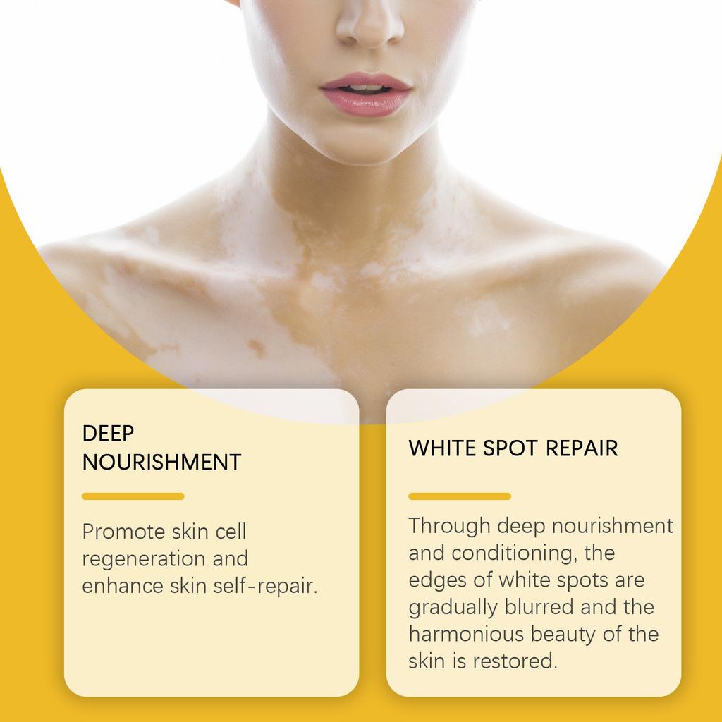 Vitiligo Relief Cream, Skin Care Cream, Vitiligo Cream, Improves Dryness, Suitable For All Skin Types