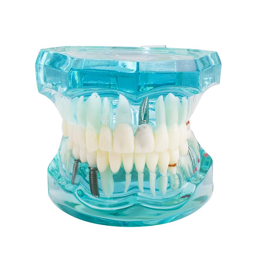 Dental Study Tooth Transparent Adult Pathological Teeth Model