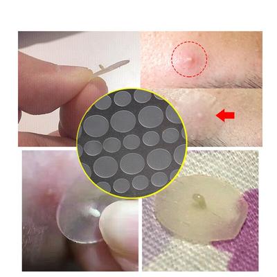 36/72/108 шт. наклейка для удаления прыщей против прыщей, пластырь для лечения угрей, пластырь от прыщей, маска для ухода за лицом, инструмент для ухода за кожей