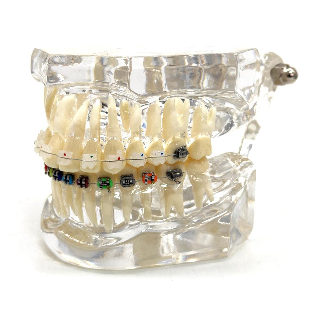 1 шт., стоматологическая ортодонтическая модель, связь с пациентом, 2 вида брекетов с дугами, лигатуры, керамический брекет, металлический краевой брекет