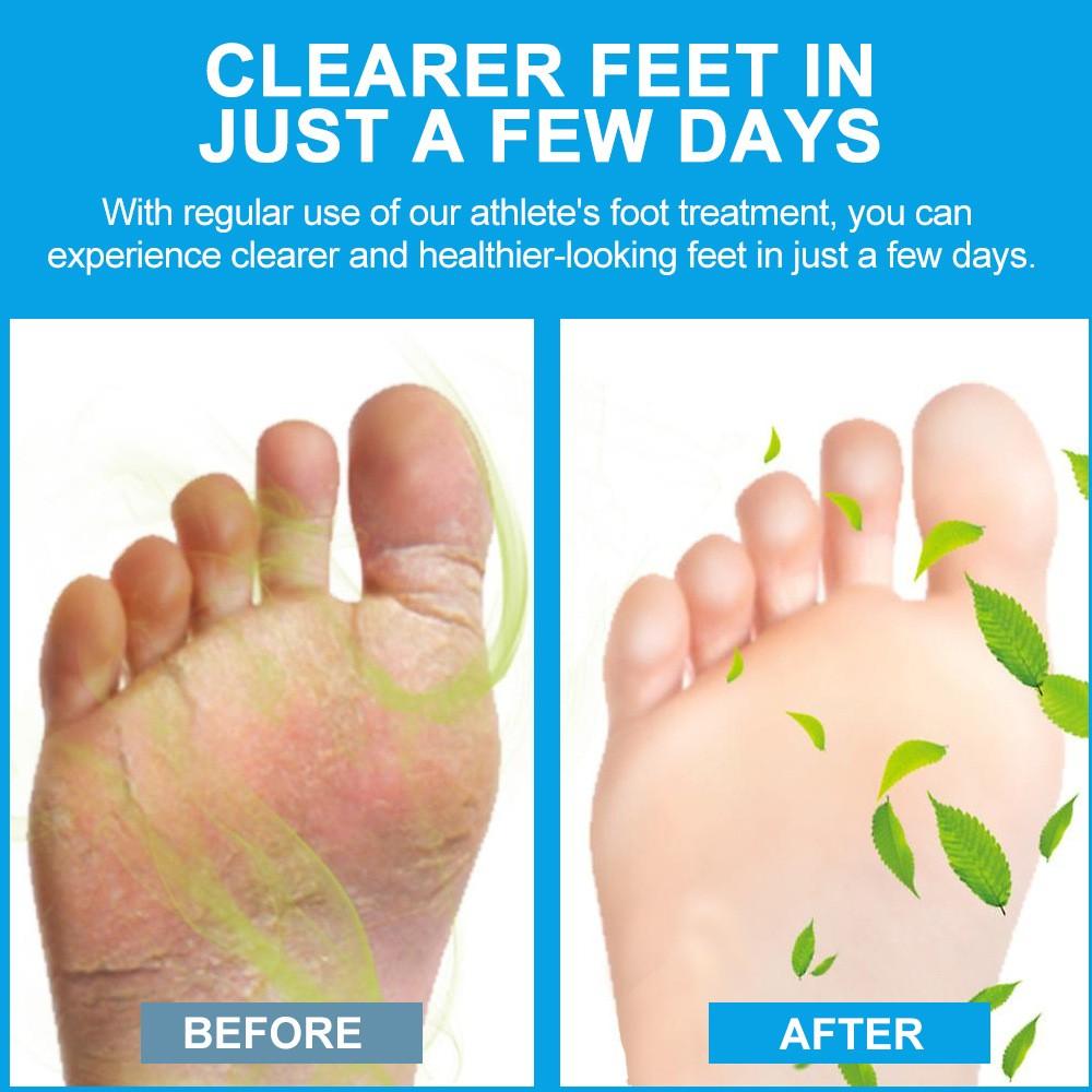 Дезодорант для ног Борьба с запахом ног, гель для ухода за ногами из натуральных ингредиентов, запах ног, потные ноги, уход за ногами, 20 г/0,70 унции
