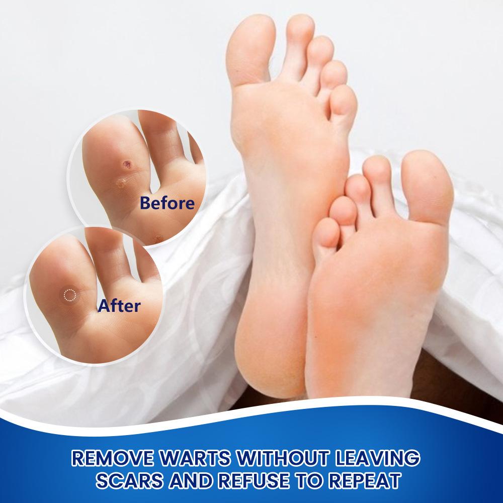 20 г крем для удаления мозолей на ногах Killer Foot Protection обезболивающий лечебный крем для лечения мозолей