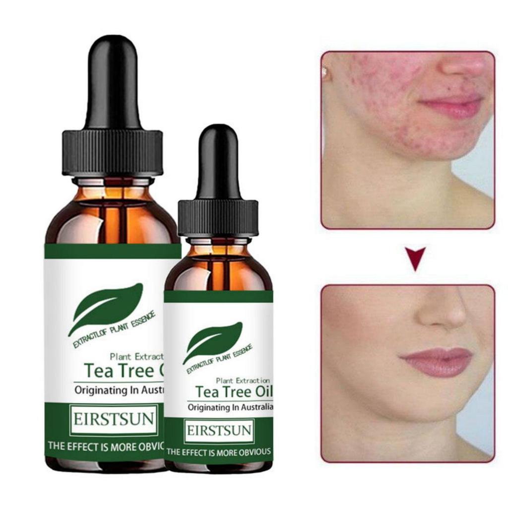 5 мл/15 мл/30 мл/50 мл/натуральное масло чайного дерева, увлажняющее, для лица, тела, женский уход за кожей, восстановление кожи, увлажняющее, ароматерапия, чистое массажное эфирное масло