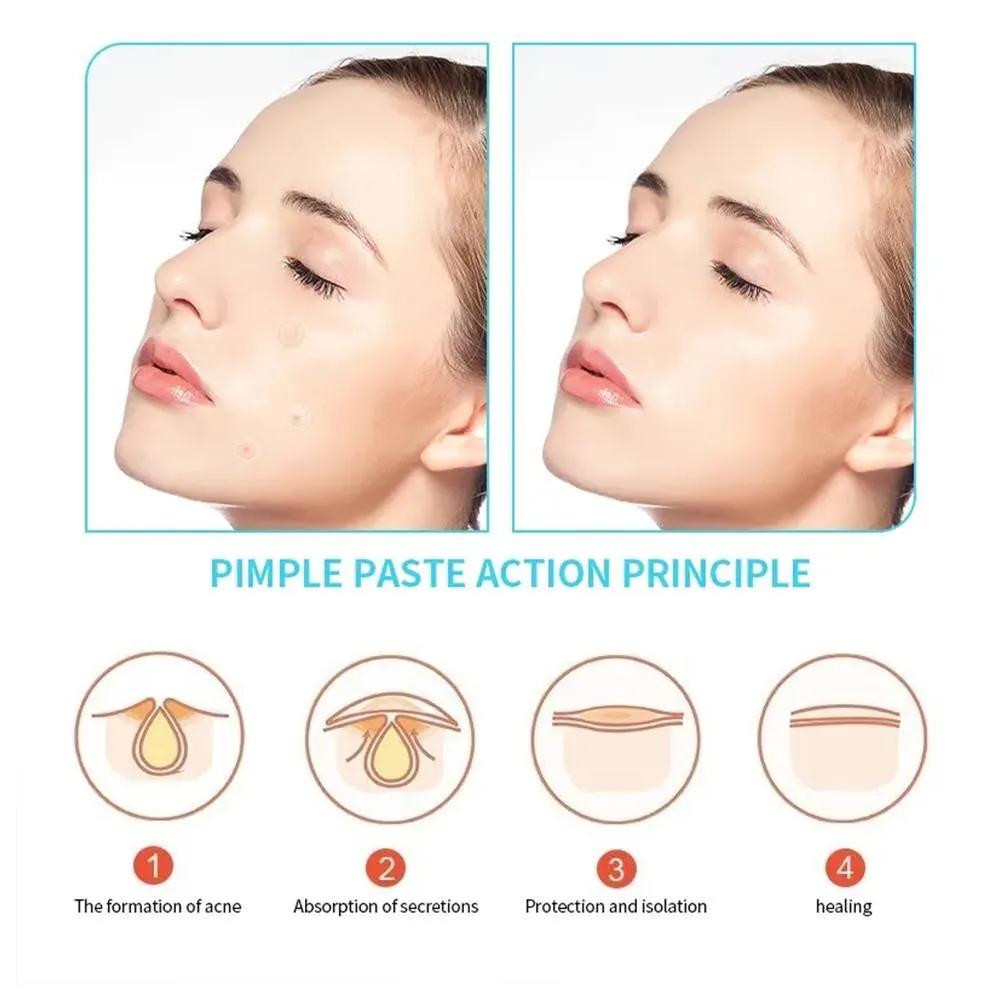 Acne patches for pimple treatment, hydrocolloid acne patches for face and skin, 36 pcs