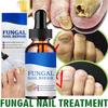 South Moon Repair Nail Fungus Treatments Essence Foot Care Serum Toe Nails Fungal Removal Gel Anti-Infection
