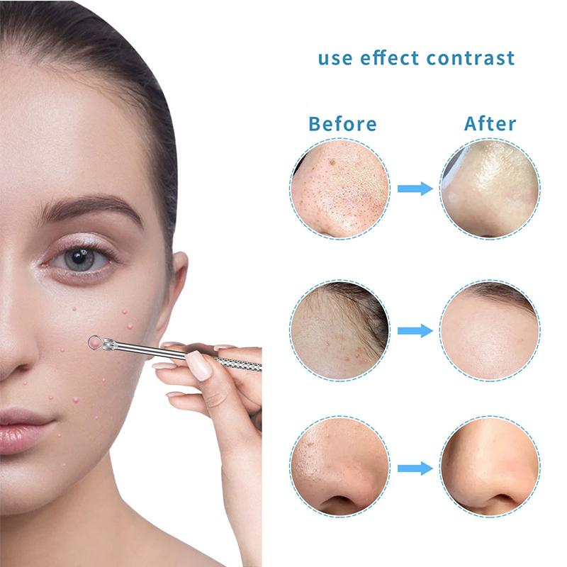 Stainless Steel Blackhead Remover Kit Comedone Extractor Acne Tweezers & Beauty Needles for White/Black Heads