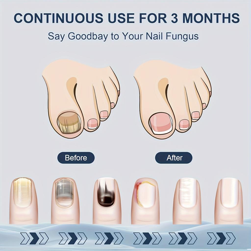 Лазерный стерилизатор для ногтей, в 2 раза более быстрое удаление и восстановление плесени, специально для ногтей с несколькими пальцами, складное оборудование для очистки от плесени