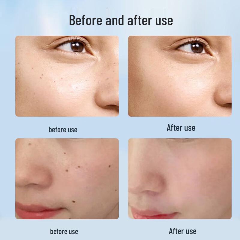 Портативная лазерная пикосекундная ручка для удаления пигмента