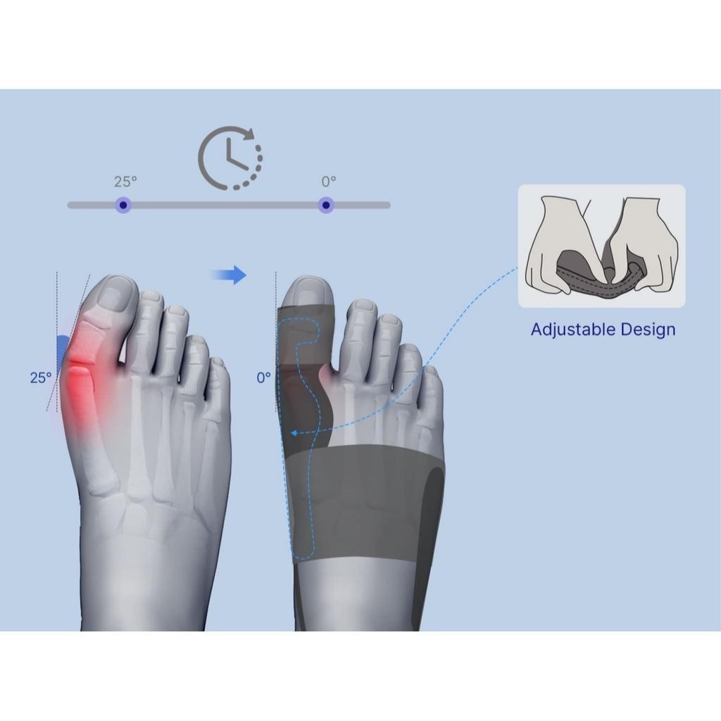 Bunion Pad Women & Men Big Toe: Foot Straightener Splint Brace 2pcs