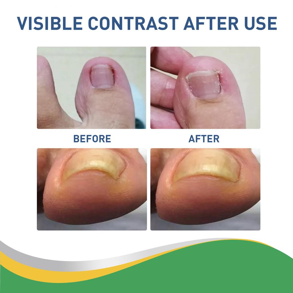 50 Pcs/Set Nail Ingrown Stickers Double-sided Adhesive Ingrown Toenail Correction Ingrown Toenail Correction Tool Elastic Patch Stickers