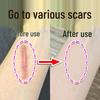 Крем для восстановления кожи от акне и шрамов: Осветление шрамов, Заживление ожогов, Осветление гипертрофических и послеоперационных (кесарево сечение) шрамов
