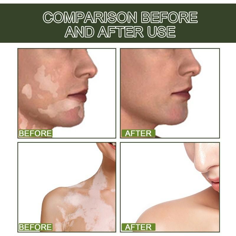 Eelhoe White Spot Repair Serum For Skin Brightening Moisturizing And Nourishing Care