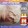 Gentle Herbal Balm for Rough & Cracked Hands Feet - Natural Skin-Safe