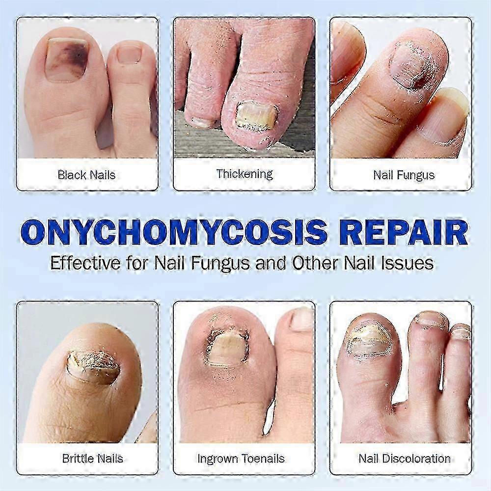 2025 Fungus Patch Waterproof Nail Repair Patches, Ingrown Nail Correction Stickers, 1/2/3/4/5pcs for Discolored or Damaged Nails
