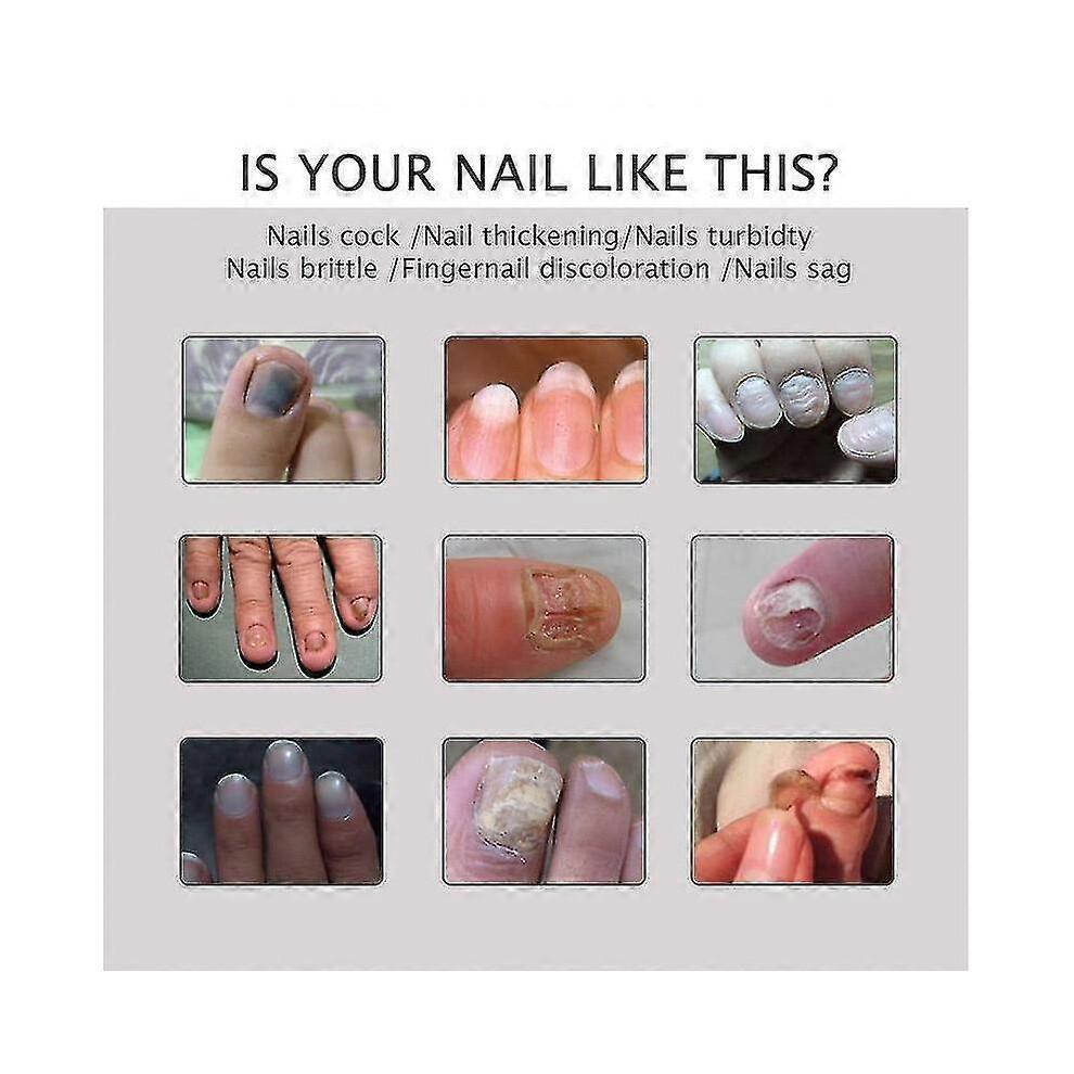 3x Efero Nail Exfoliation Plant Nail Repair Fluid Nail Cream Nail Treatment Gel Nail Repair Gel Moisturizing Nail Luster Tw