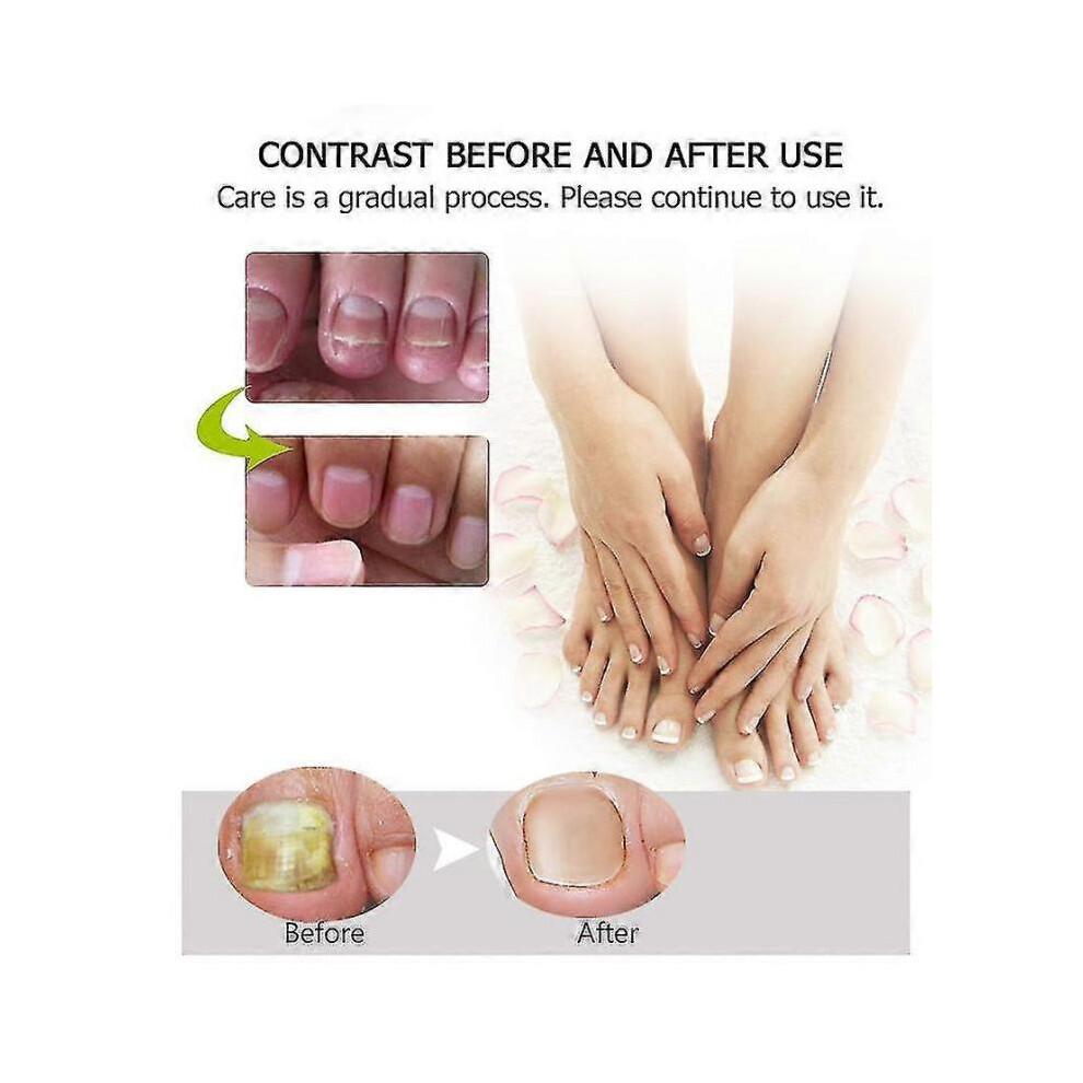 3x Efero Nail Exfoliation Plant Nail Repair Fluid Nail Cream Nail Treatment Gel Nail Repair Gel Moisturizing Nail Luster Tw