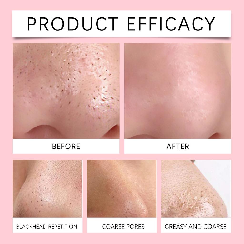 Nose Patch Care Series Gentle Cleansing Of Pores, Nose T- Care, Moisturizing And Hydrating Nose Care Patch