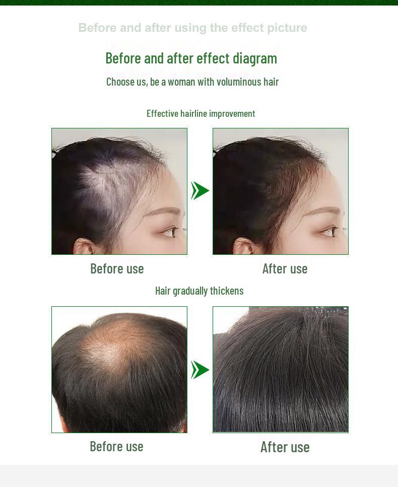 Регулируемый мезороллер для красоты и роста волос - Штамп DRS140A, локальное увлажнение, настройка длины игл, рост волос - Модель 120A