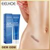 Herbal Acne Scar Removal Cream Stretch Marks Remove Face Body Burn Surgical Scars Treatment Scar Remove Serum