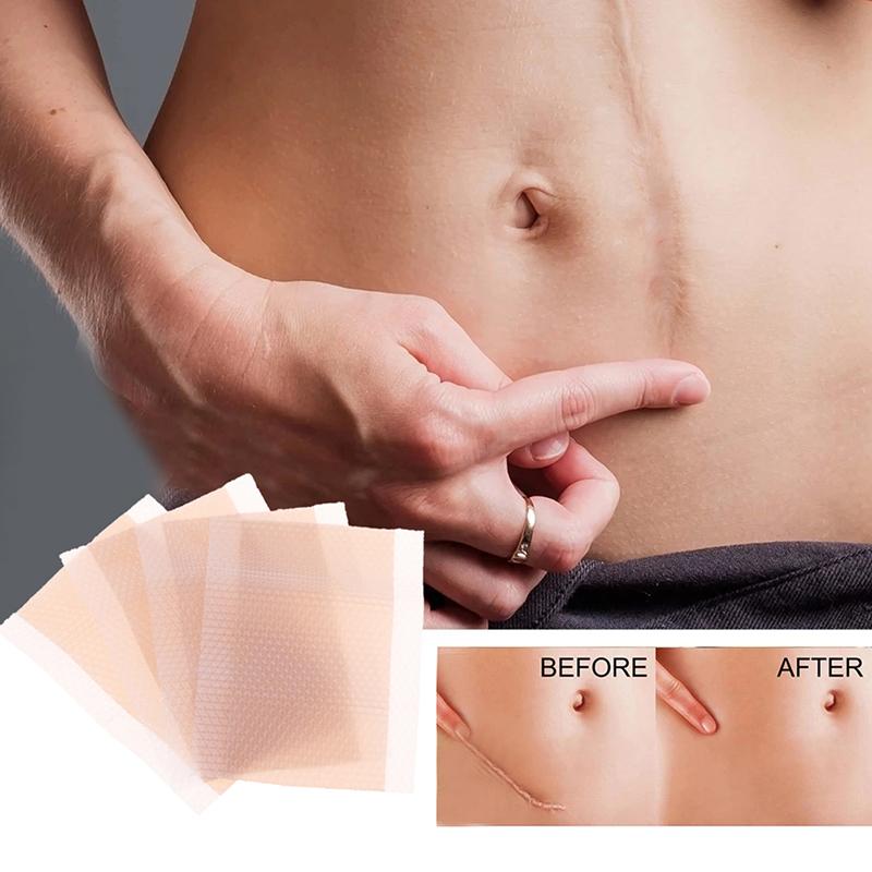 Хирургическое удаление шрамов, наклейка, пластырь, силиконовый гель, эффективное лечение шрамов